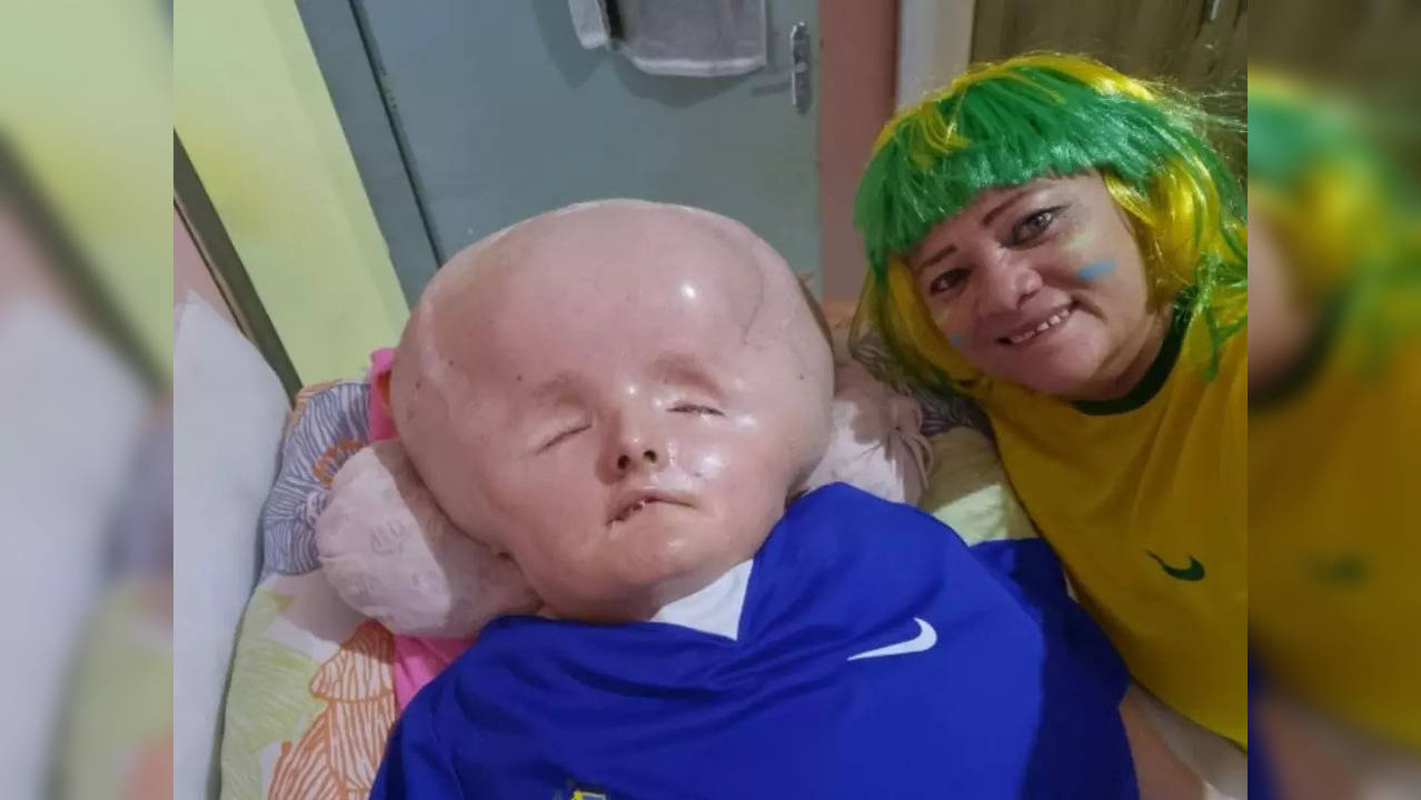 Girl Struggles With An Absurdly Large Head Due To A Rare Disorder