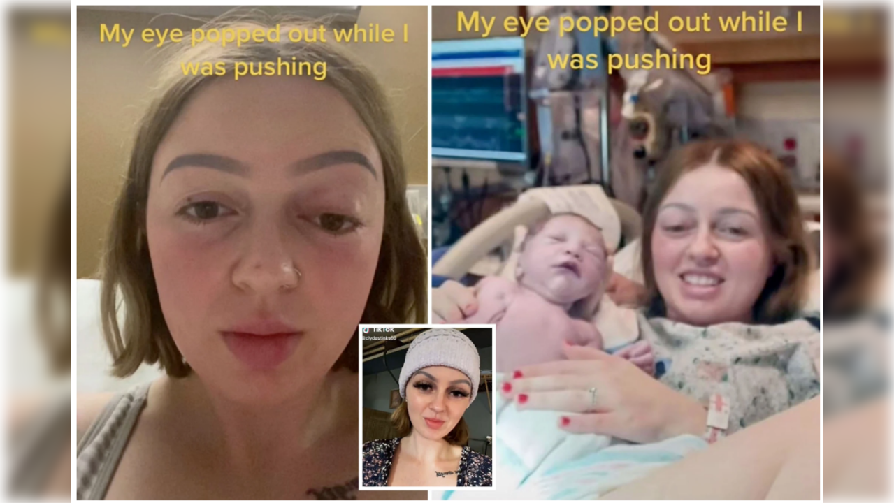 Uk Woman Pushed So Hard During Labour That Her Eye Popped Out Could