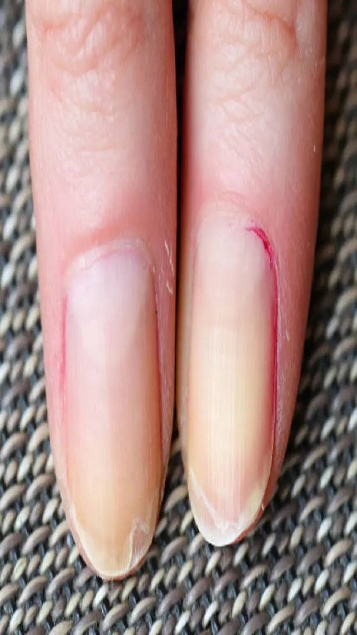 White Spots On Your Nails Causes & How To Get Rid Of Them, ASAP | Glamour UK