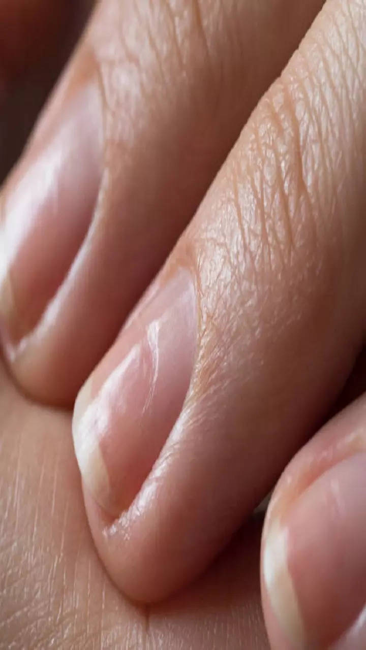 Discover What Those Nail Dents Reveal About Your Health + the Nail Symptom  that Can Be the First Sign of a Slow Thyroid