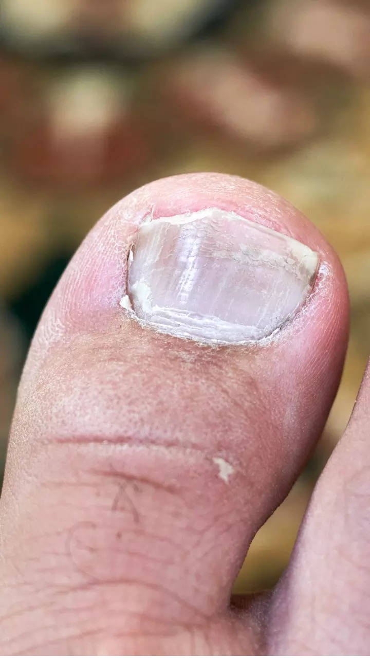 What is this black line on my thumb nail? - Quora