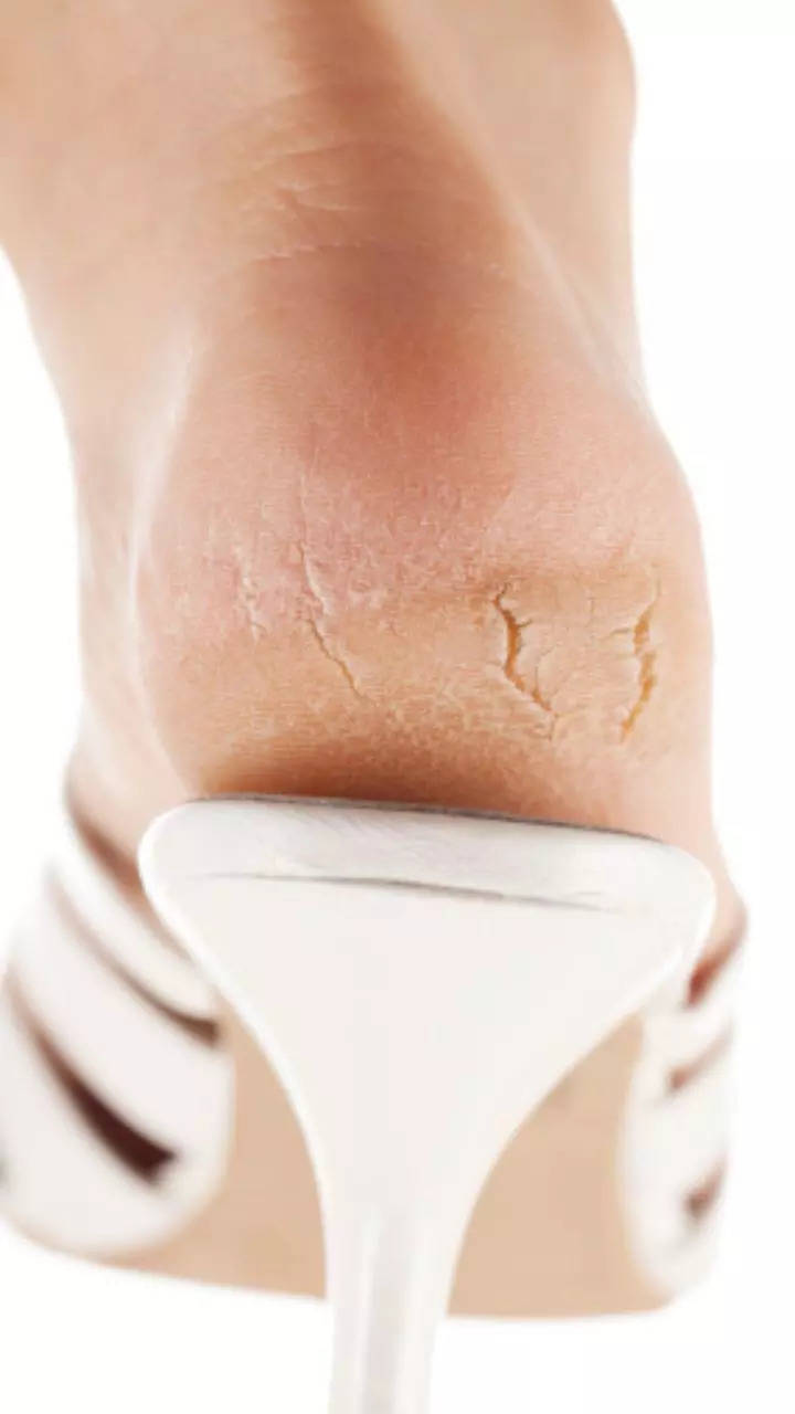 Home Remedies for Cracked Heels That You Need to Try Out - AllDayChic