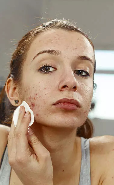 8 Effortless Home Remedies That Reduce Pimples Naturally