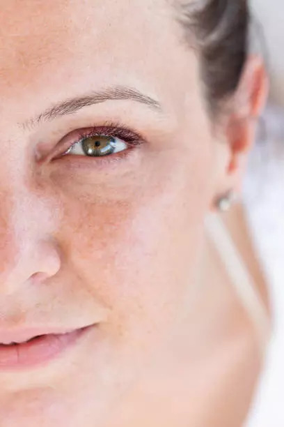 8 Natural Remedies To Get Rid Of Dark Spots