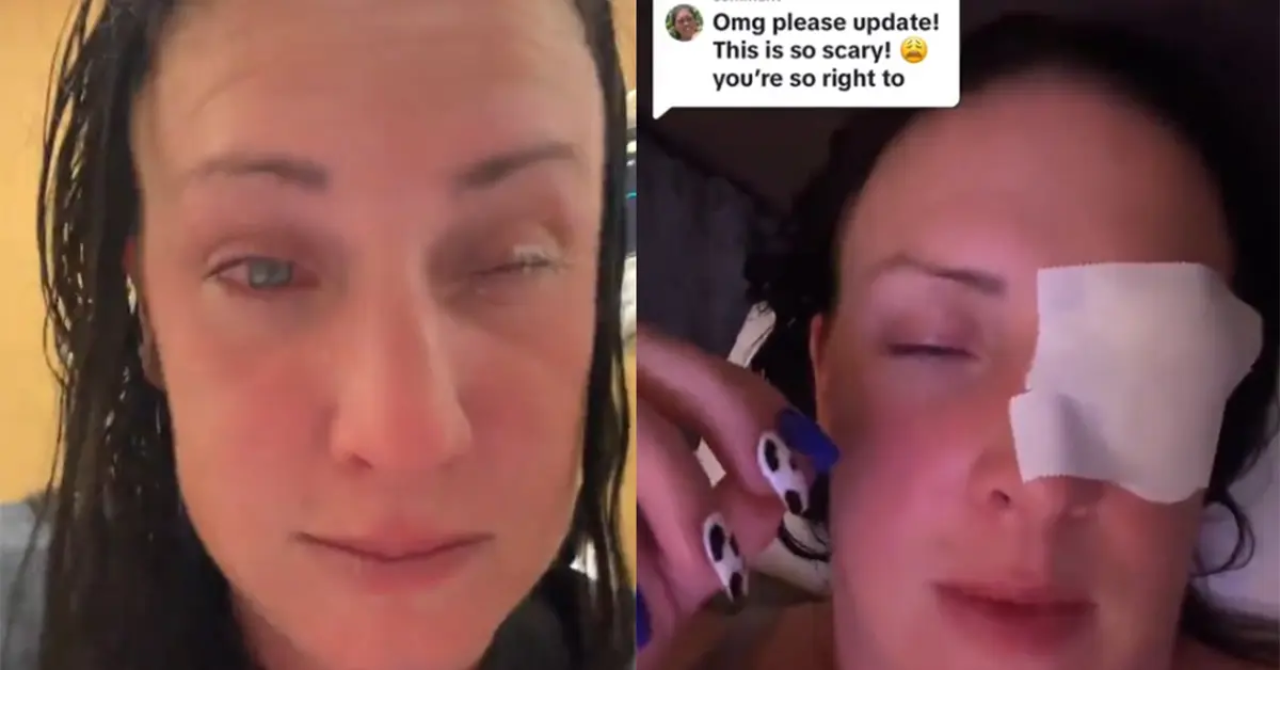Woman ends up in hospital after mistaking Superglue for eye drops recounts her recovery on social media