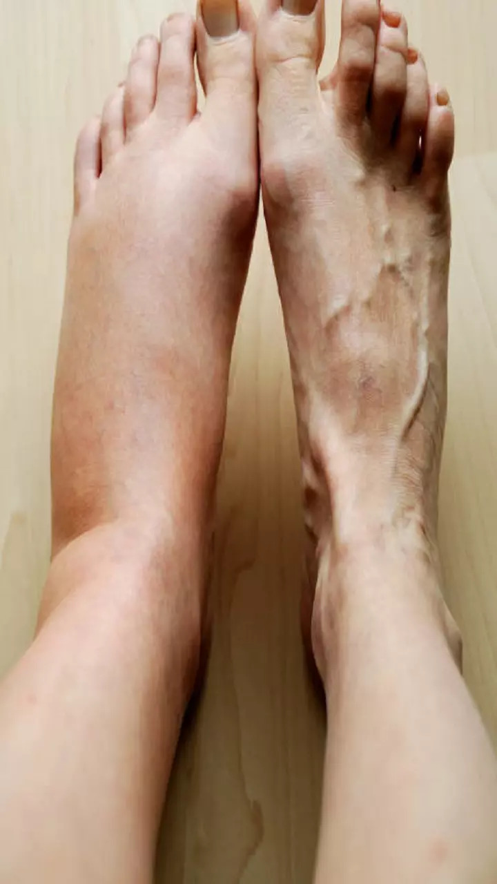 Swelling of the legs or ankles