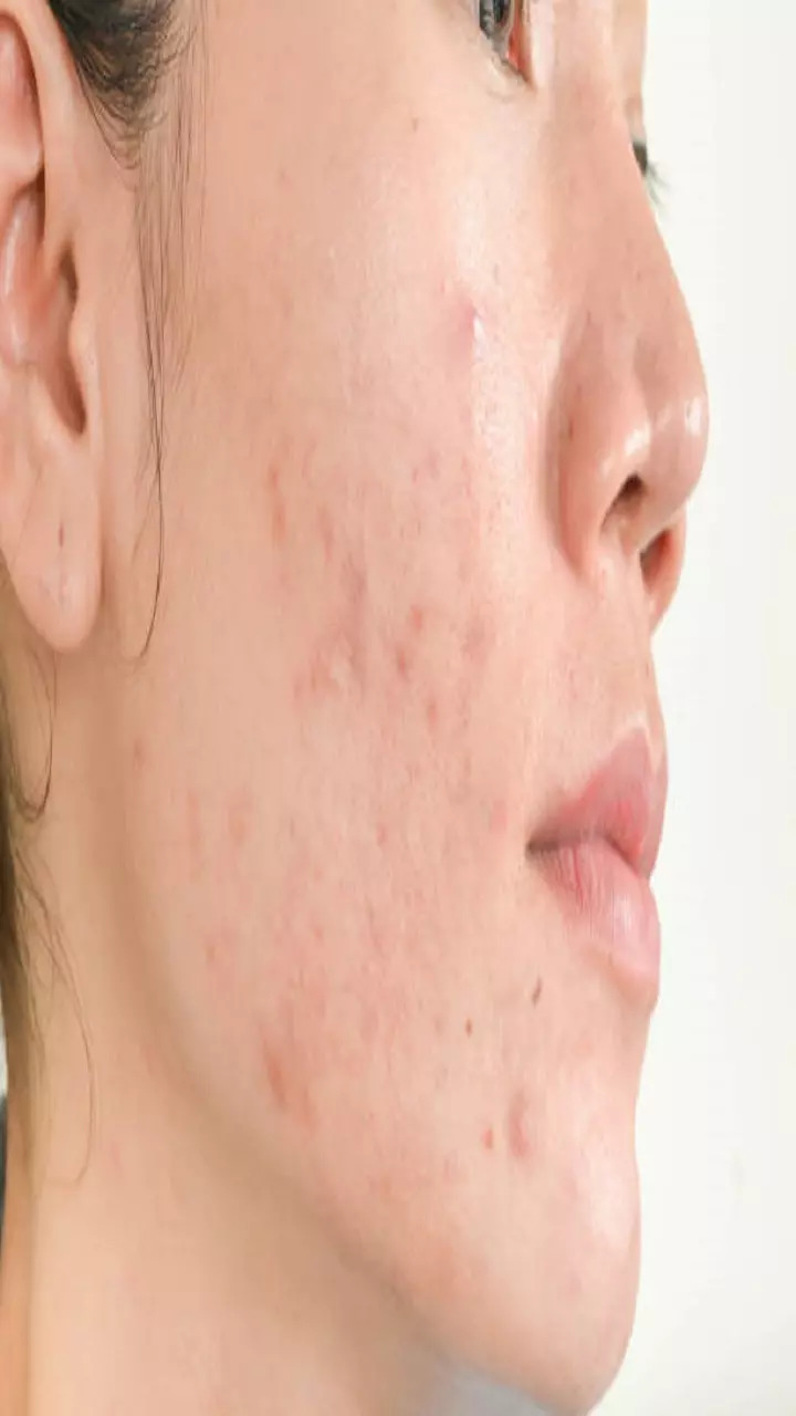 10 Simple and Natural Ways to Deal With Acne Problem at Home