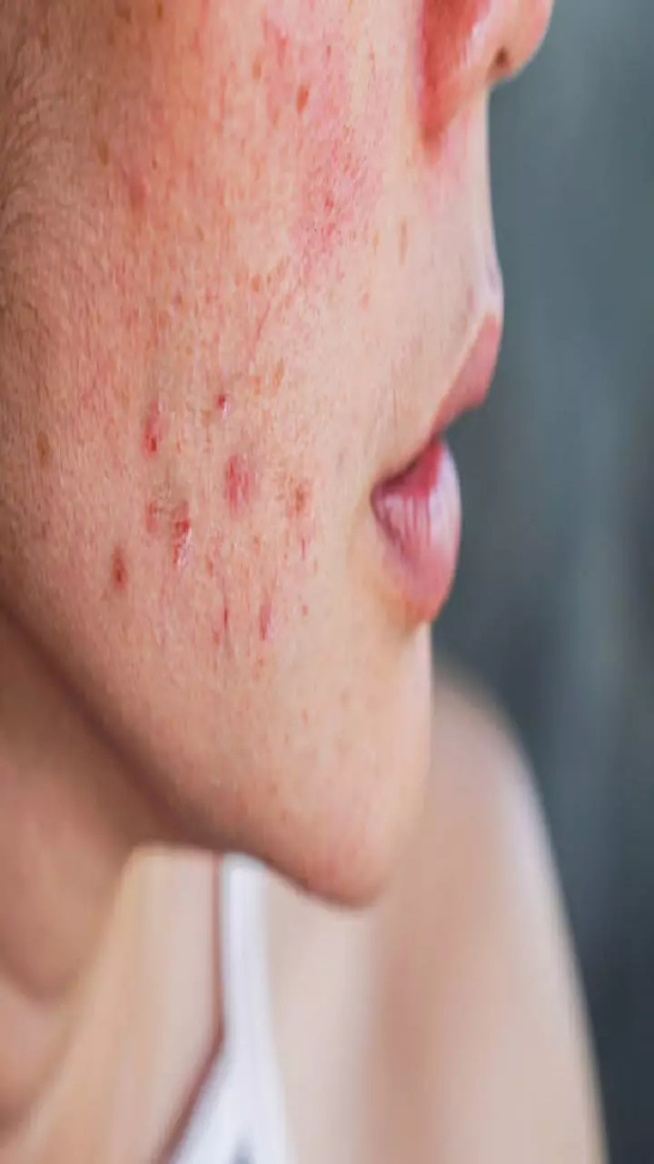 How to deal with the problem of acne