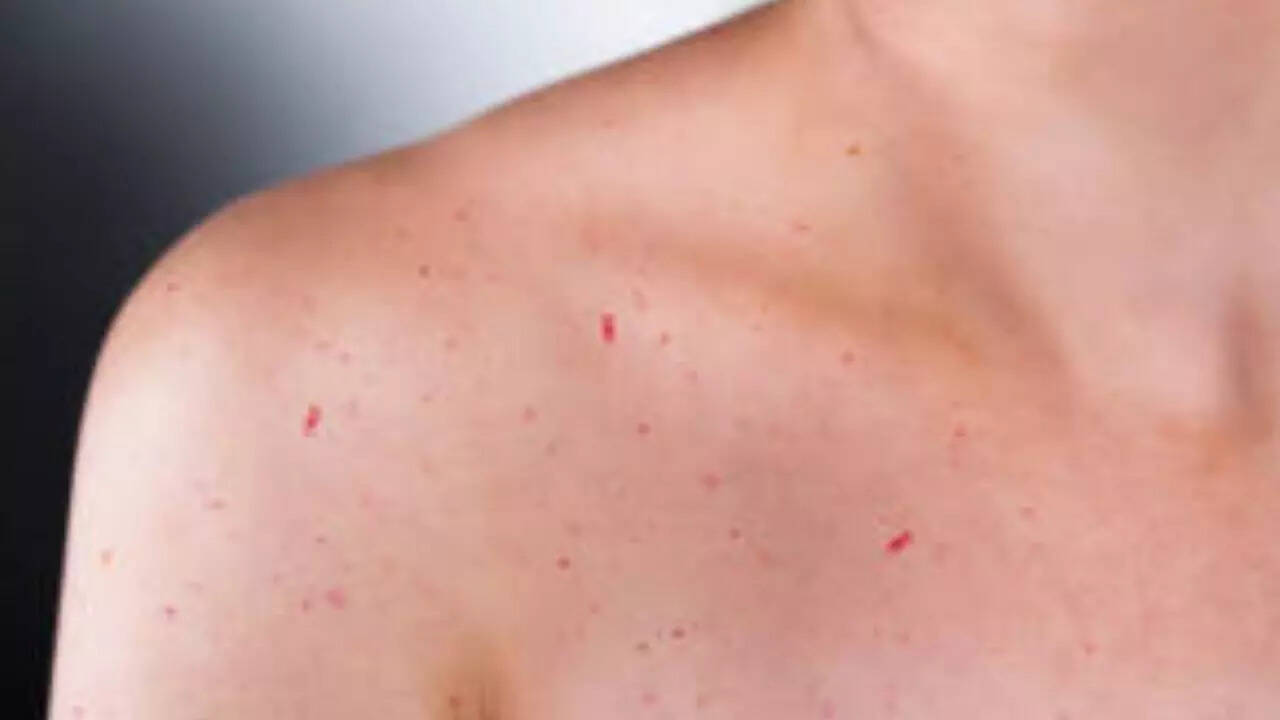 Moles On Your Body Learn Your Personality Secrets with Simple Body Signs