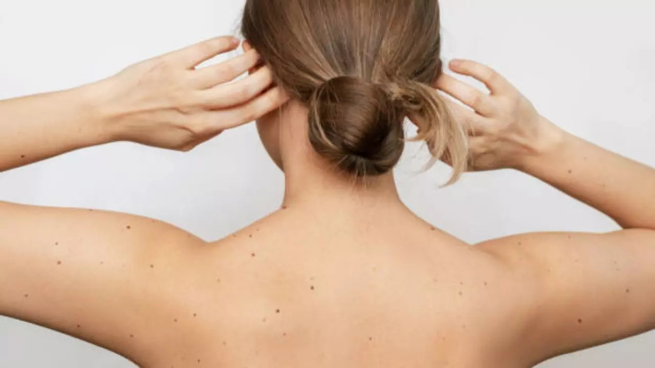 Moles on Back