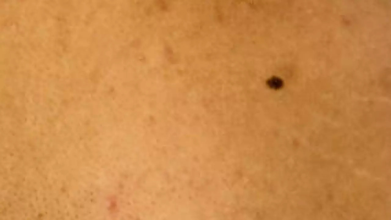 Moles on Genitals