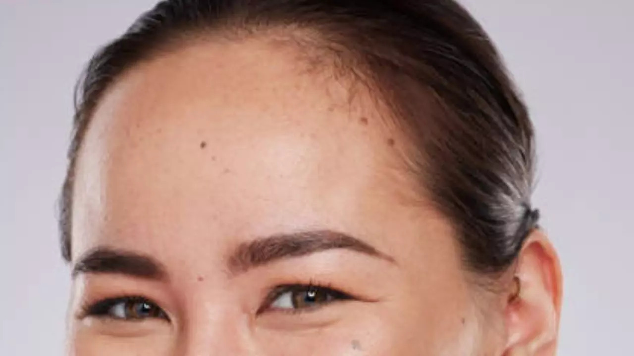 Moles on Forehead