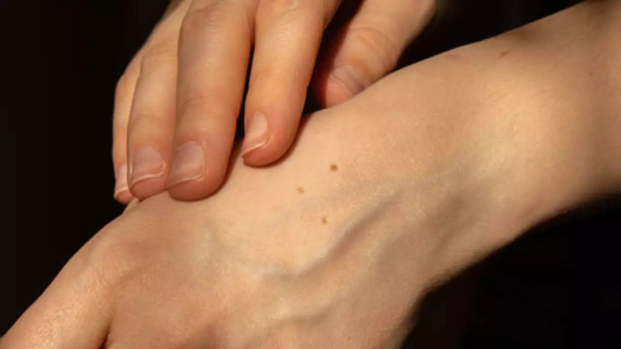 Moles on Hands