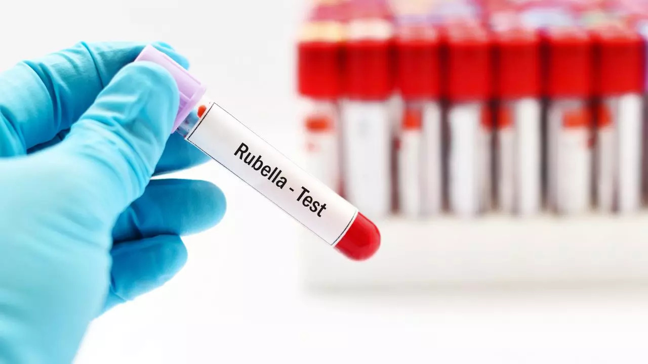 Rubella Immunity Testing