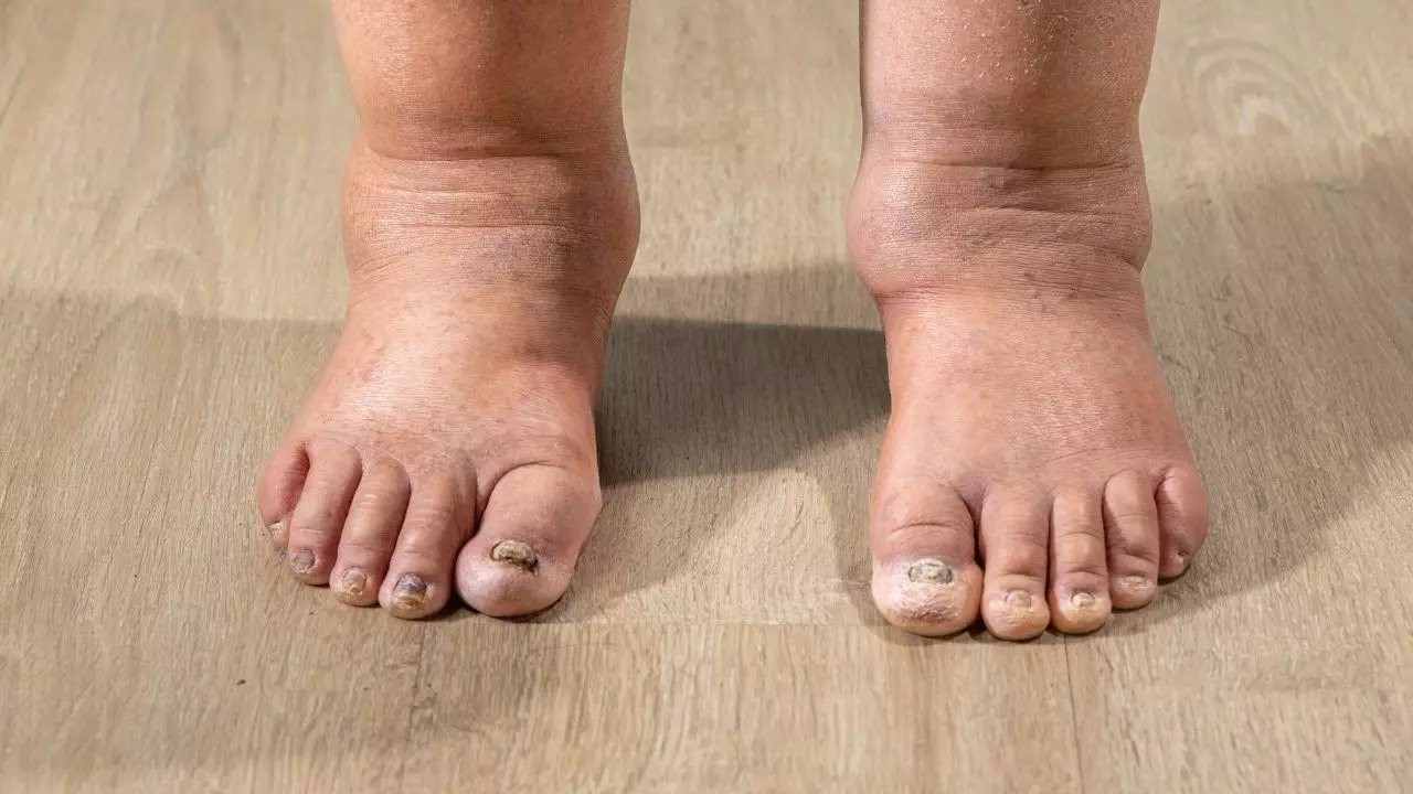 Swelling Oedema