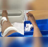 Bengaluru Woman Says Never Taking Rapido Again Shares Photo Of Injuries