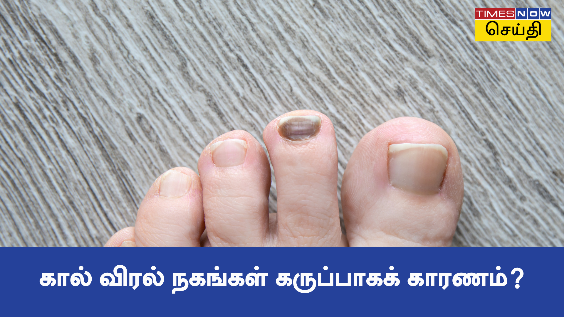 Black Toenail கால் நகம் கருப்பாக காரணம் என்ன 