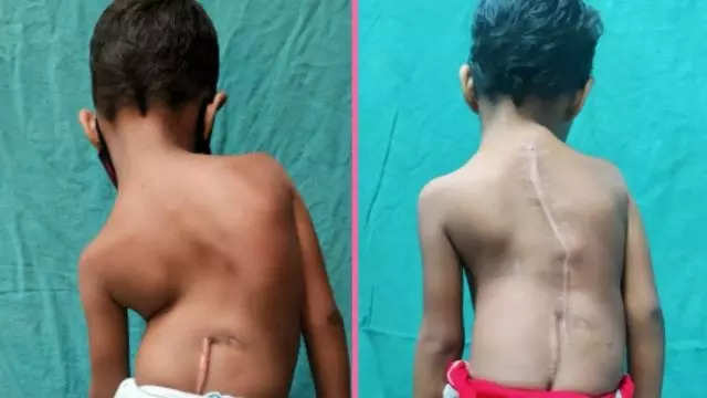 Congenital Scoliosis