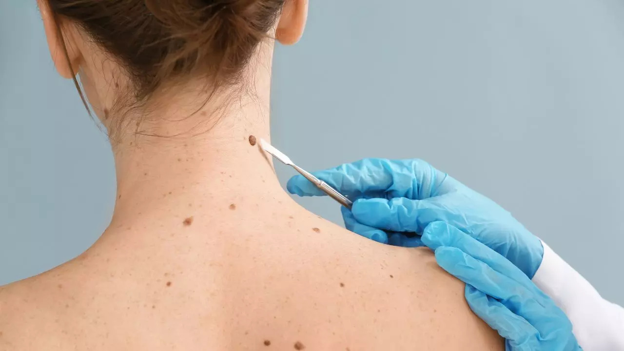 Skin Cancer Screening