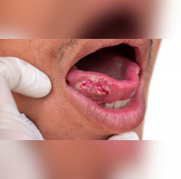 Tongue Cancer Can You Get Cancer Under Your Tongue? How Does It Spread