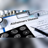 Researchers Say Brain Stimulation Device May Slow Alzheimer's Symptoms