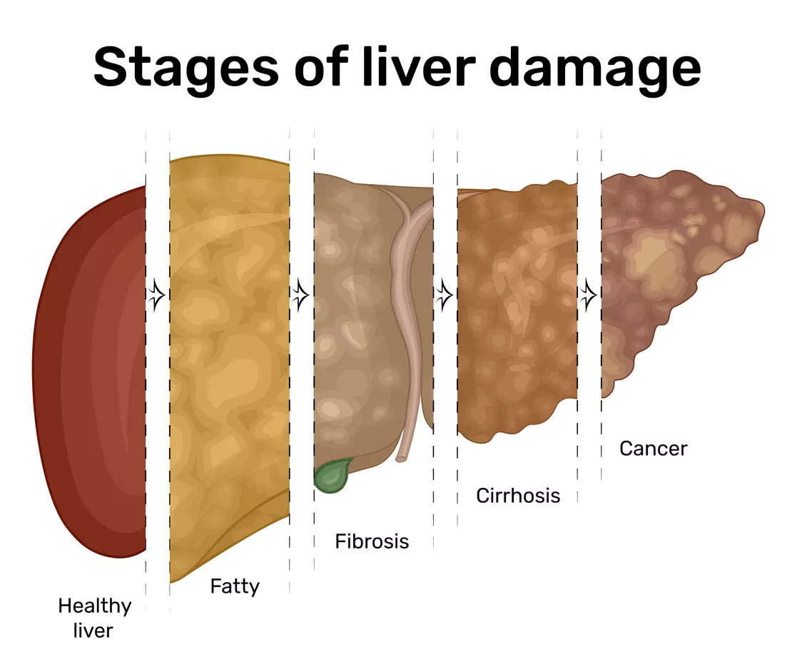 Obesity related fatty liver disease