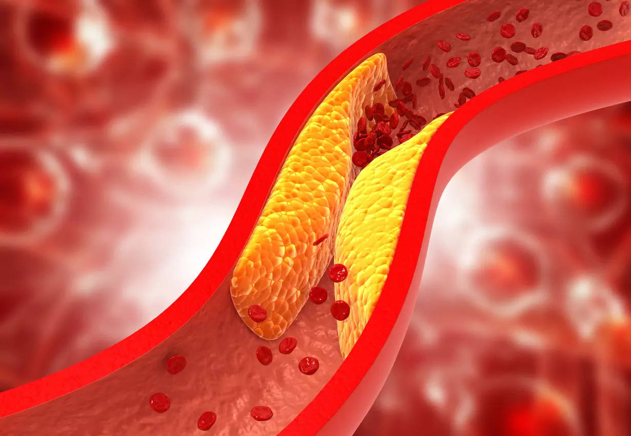 Cholesterol plaque can clog arteries.