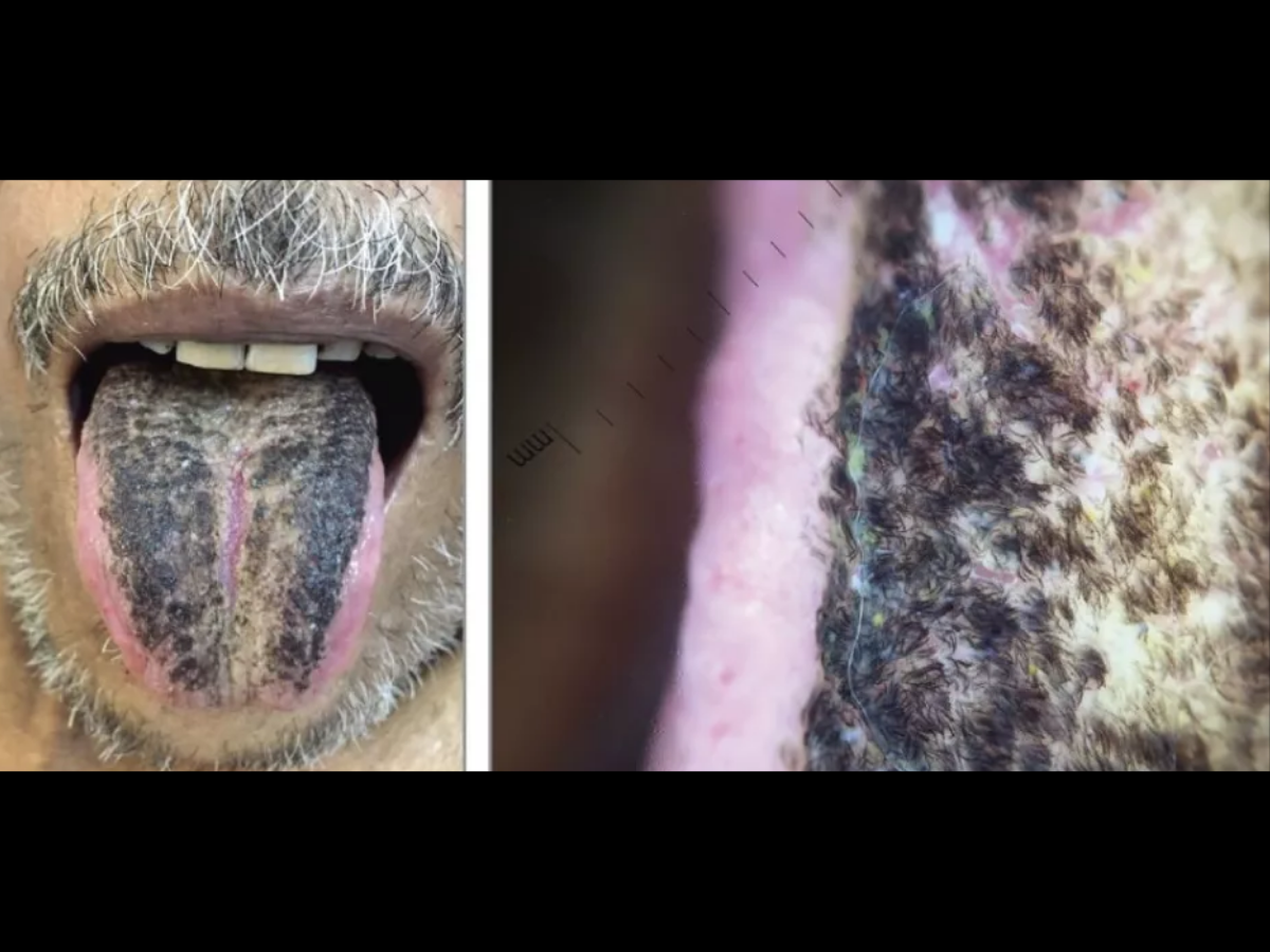 Man starts growing thick black 'hair' on his tongue - turns out it's a  common condition