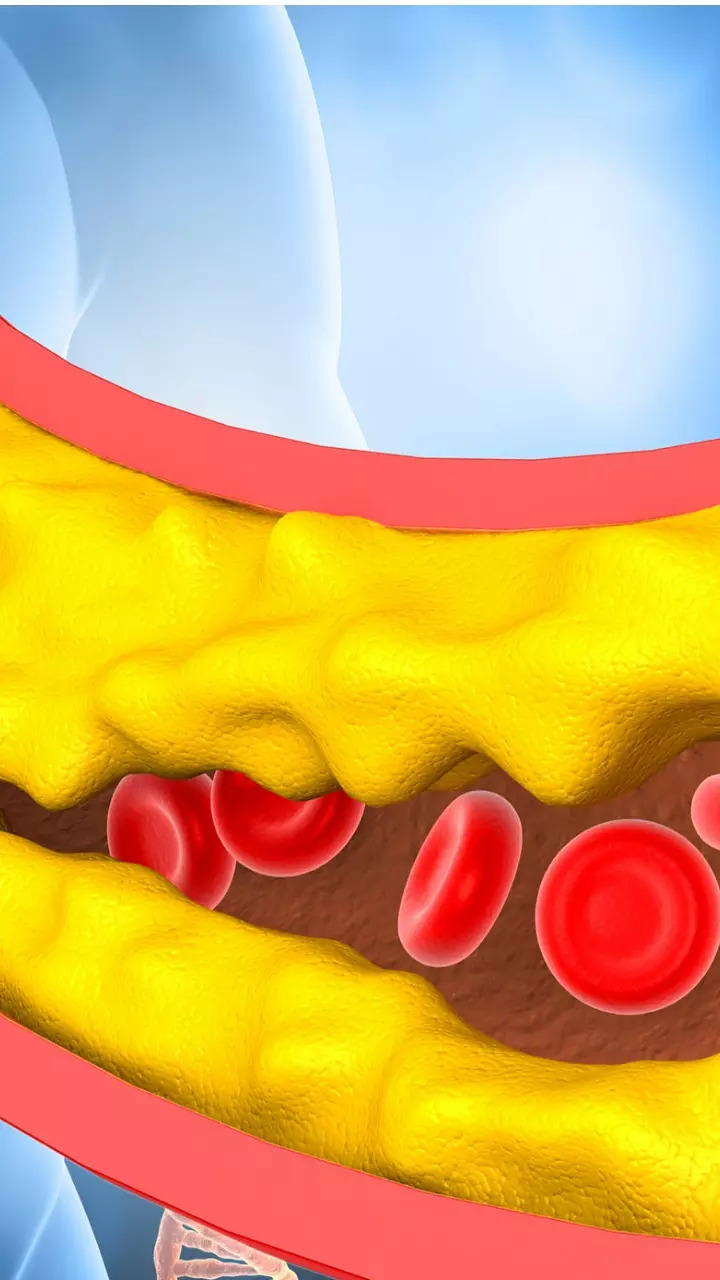 Managing high cholesterol