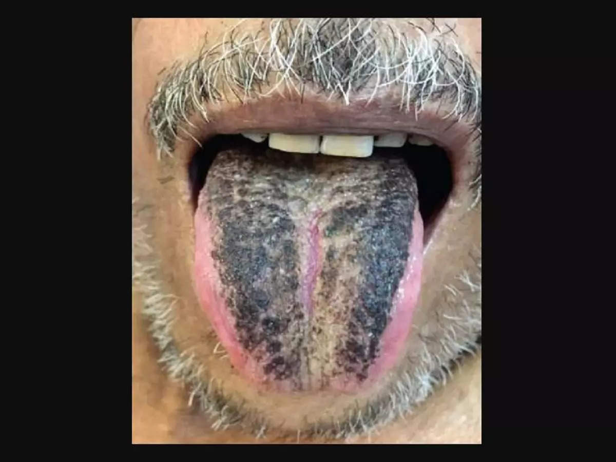 Black tongue
