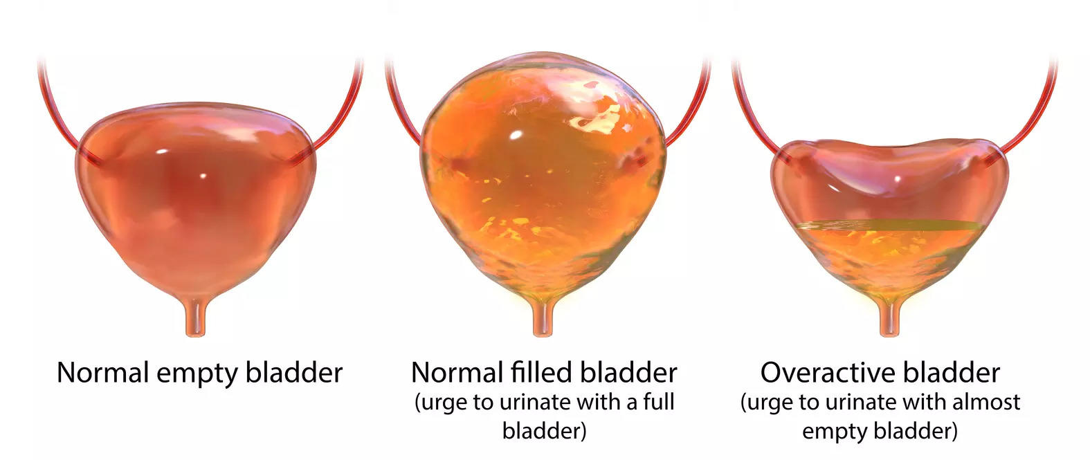 Do you feel a frequent urge to urinate? Warning signs of overactive bladder that you must not miss
