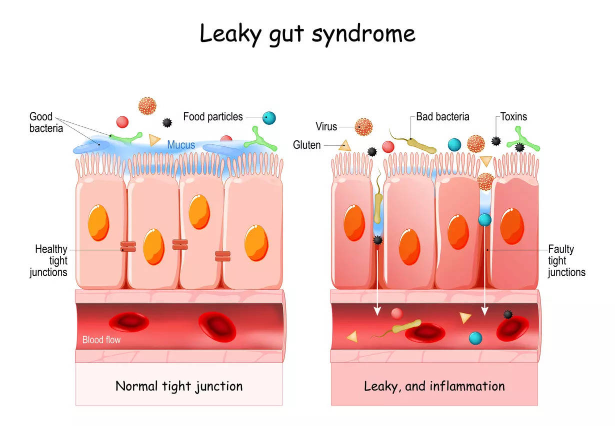 Leaky Gut syndrome explained