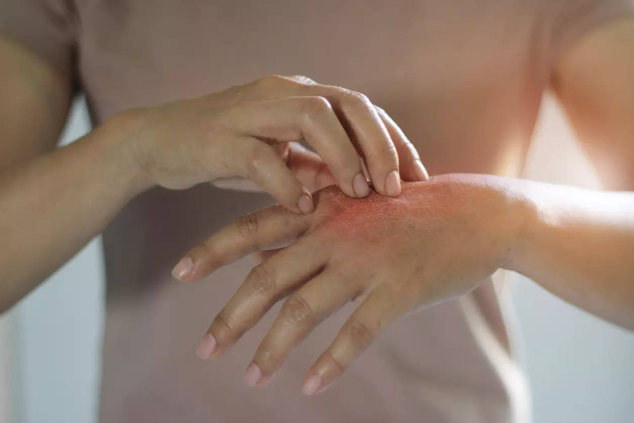 Skin health: Know about 5 most common disorders and their symptoms