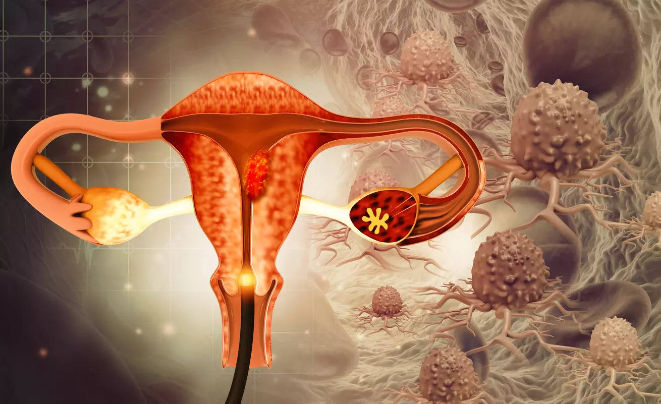 Ovarian cancer: Top 3 silent signs that often go overlooked, tips to reduce risk