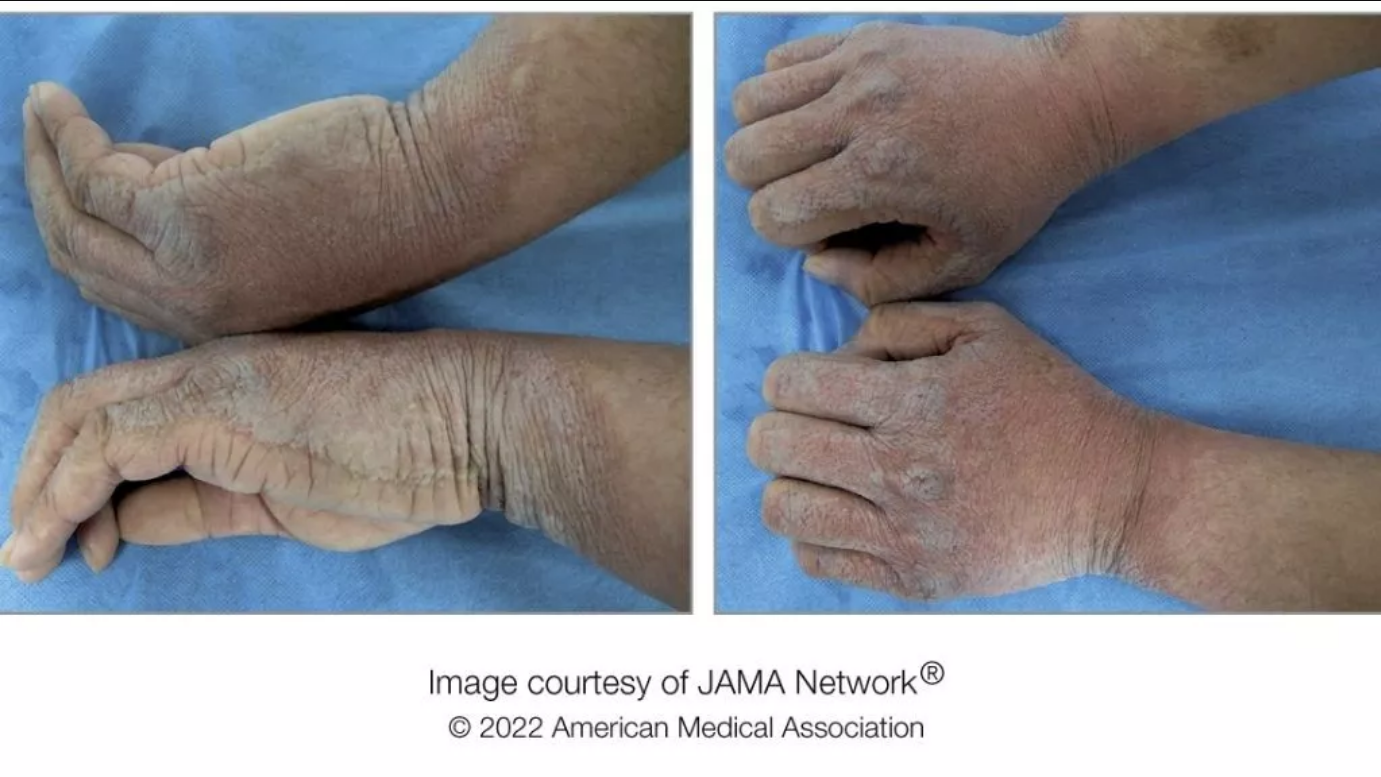 Man identified with a rare skin disease after excessive wrinkling due to water exposure