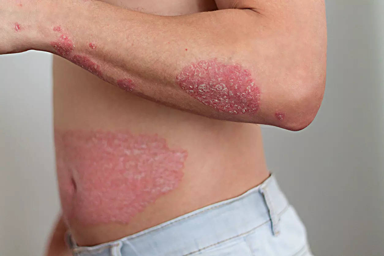Psoriasis symptoms depend on the type of the disease one is suffering from.