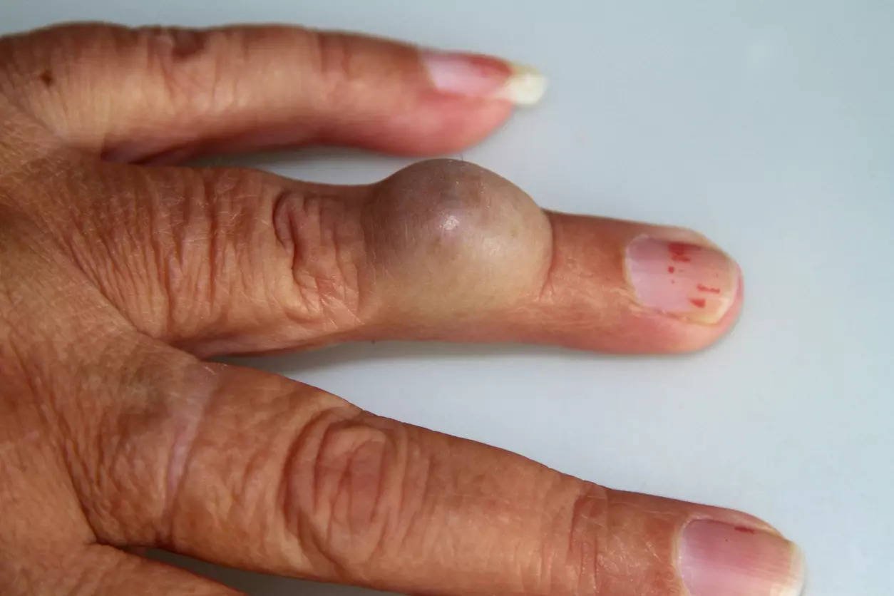 To diagnose osteoarthritis, doctors can run an array of tests initially to rule out the possibility of rheumatoid arthritis and gout as blood tests may not serve the purpose well.