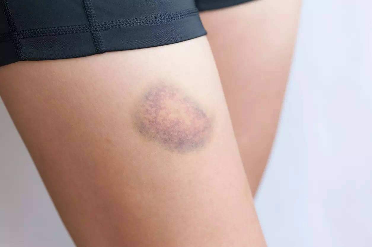 619-green-bruise-stock-photos-free-royalty-free-stock-photos-from