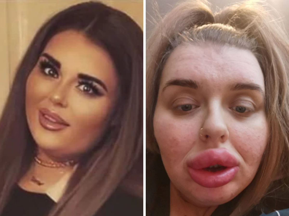 Woman left with sausage lips after allergic reaction