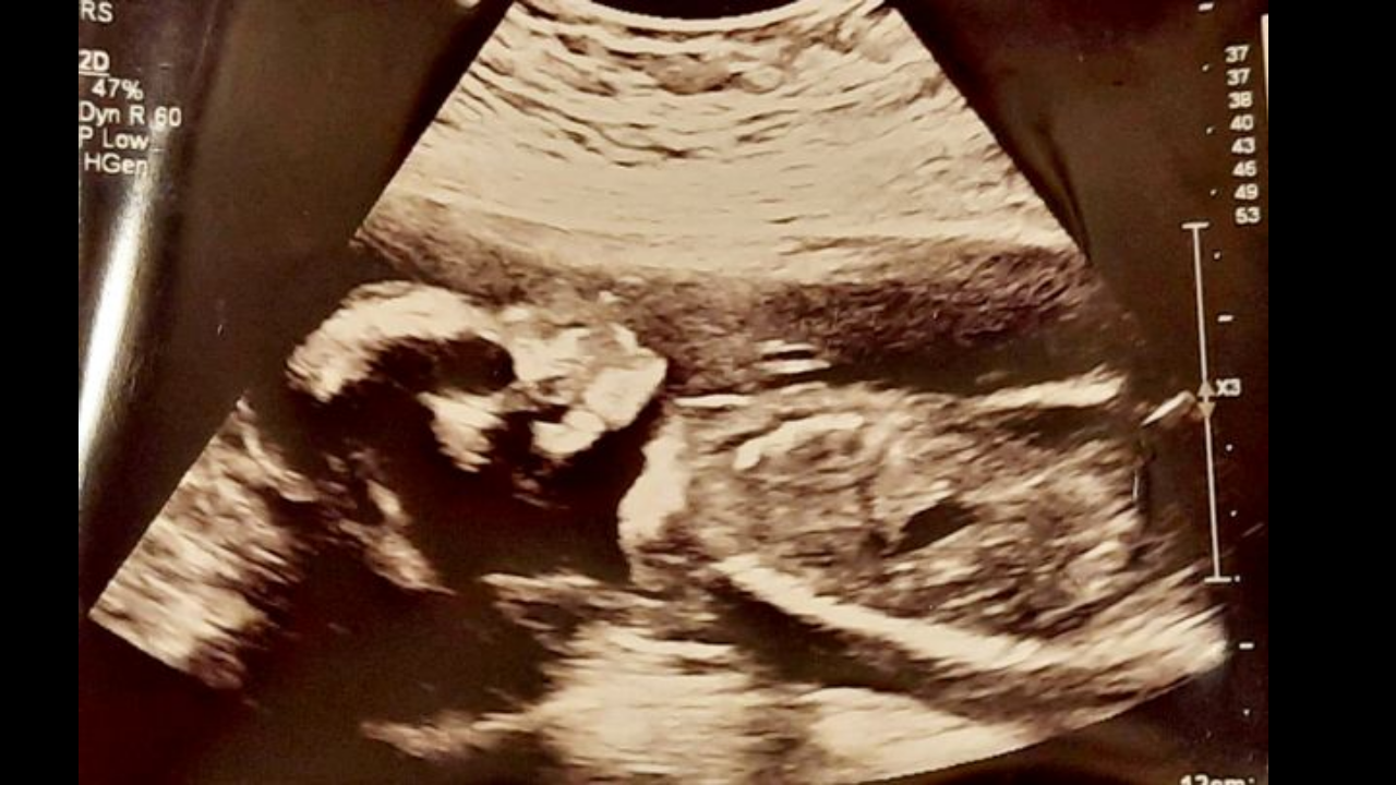 Baby ultrasound with 'scary skull'
