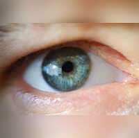 Eye health 5 reasons that could cause your eyelids to droop