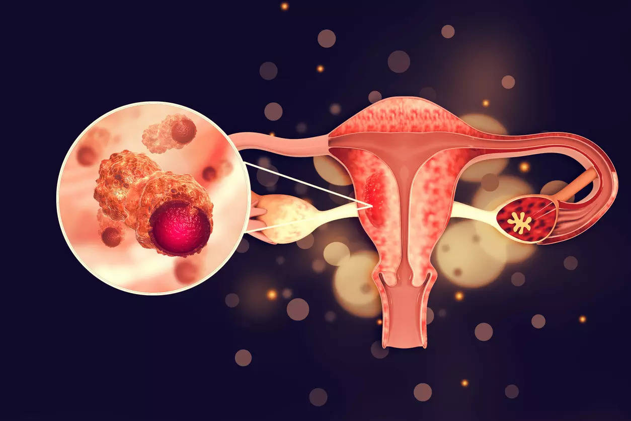 Ovarian cancer signs: Red flags to look out for