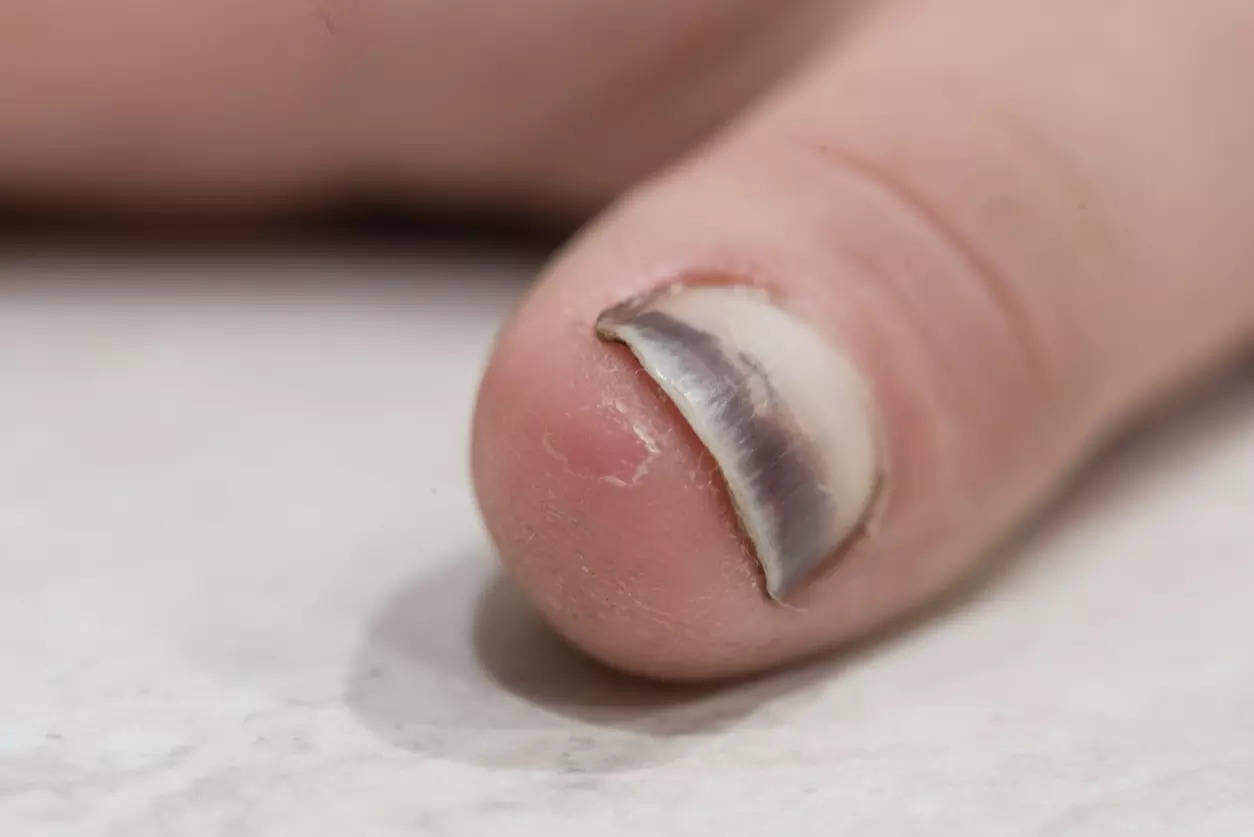 Yellow or green-looking nails could be a symptom of fungal infection or early sign of diabetes.