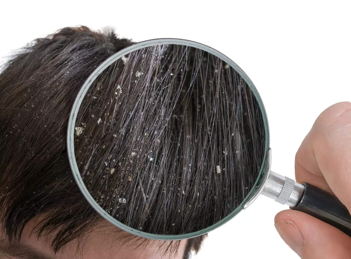 Dandruff: Know the causes and methods of prevention
