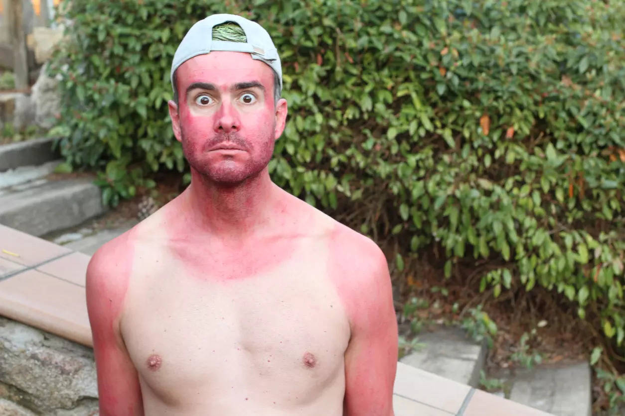 Is It Sunburn Or Sun Poisoning Know The Symptoms Health News Times Now