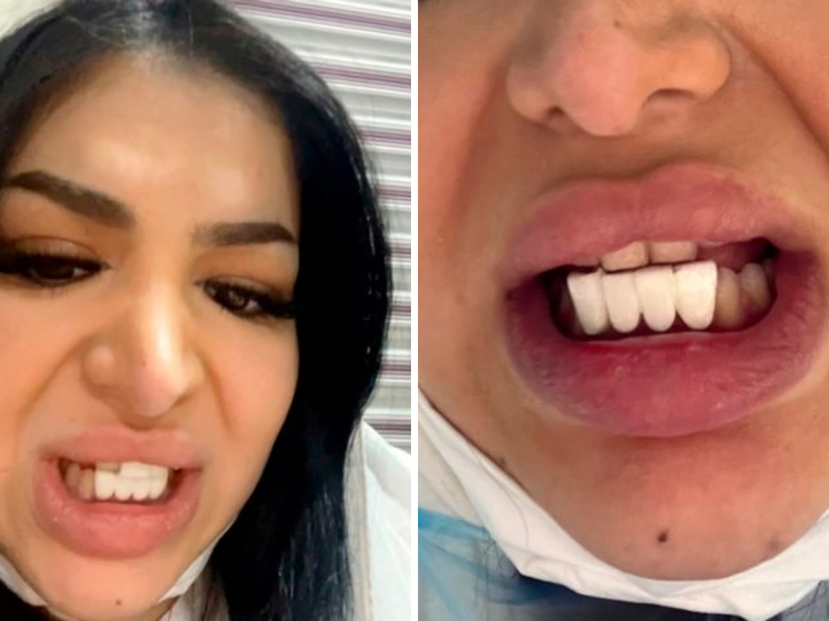 Botched dental op gives woman piano keys teeth