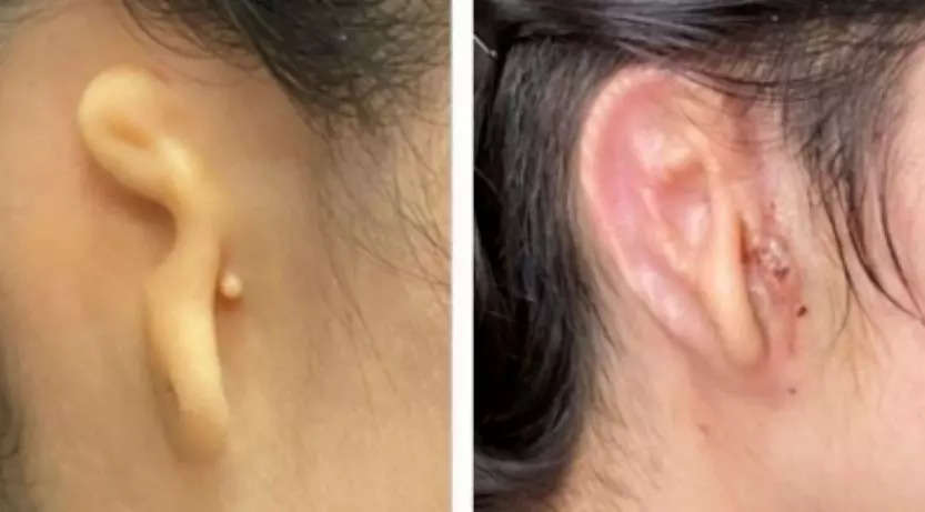 Medical Breakthrough Woman, 20, Gets 3D Printed Ear Made From Her Own Cells