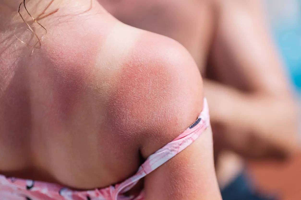 Heatwave alert Tips to keep skin safe against sun damage during summers