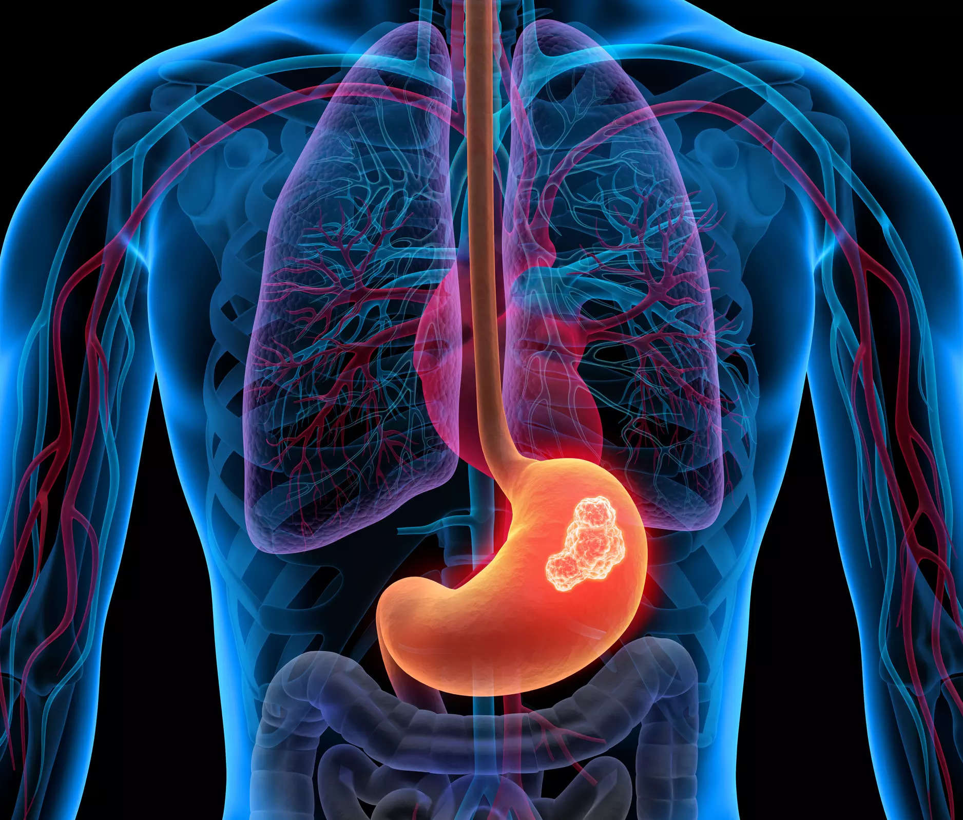 stomach-cancer-a-common-occurrence-in-india-take-note-of-its-early