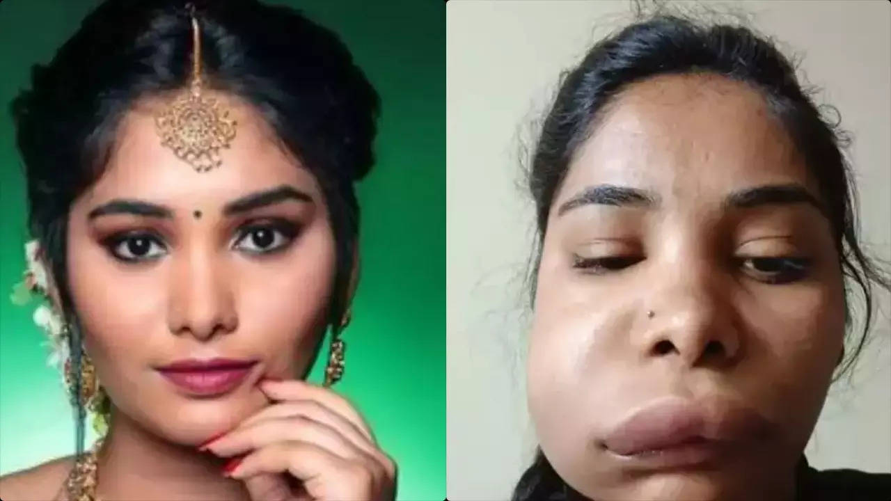 Kannada actress Swathi Sathish gets a swollen face after botched root canal surgery, shocking photos go viral